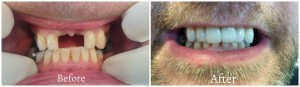 Dental Implants