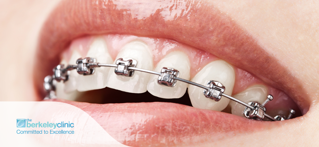 All-You-Need-to-Know-About-Dental-Braces