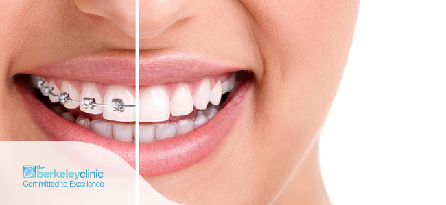 Choosing-the-right-type-of-dental-braces