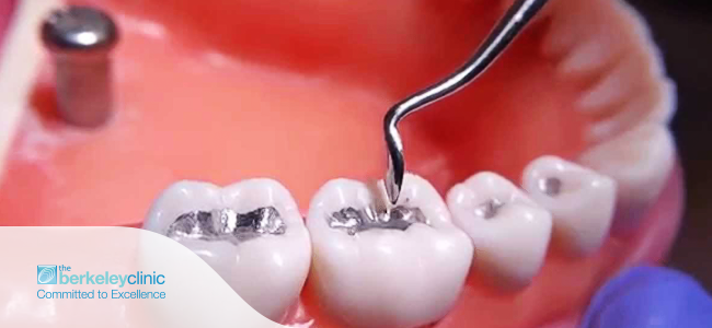 Replace-Your-Amalgam-Dental-Fillings-in-Berkeley-Dental-Clinic-Glasgow