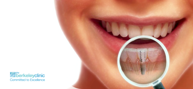 Top-8-Benefits-of-Dental-Implants