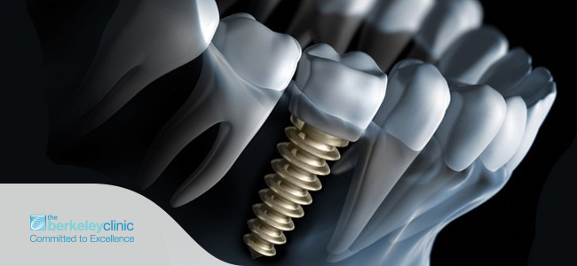 dental implants in glasgow 