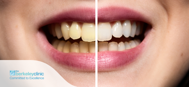 Berkeley Clinic teeth whitenin 