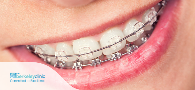 Braces For Adults: What to Know About Clear Aligners - Inner Banks Dental