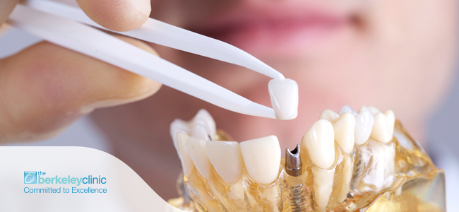 Dental Implants