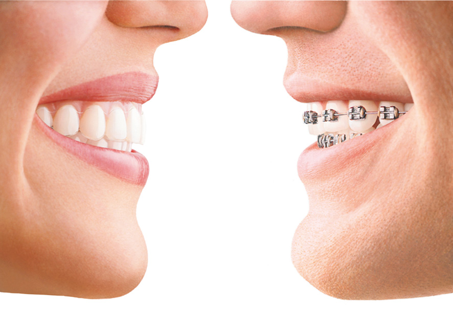 Dental braces  