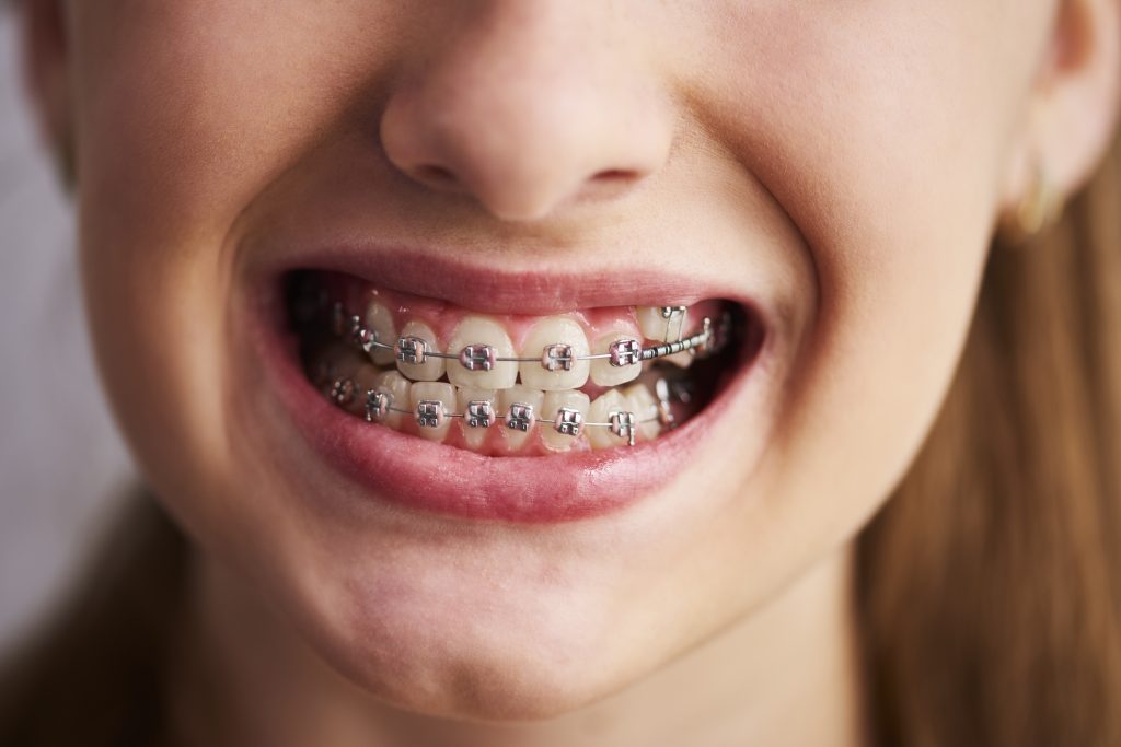 girl wearing an adult braces